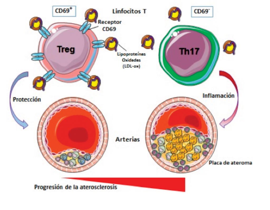 Image: A diagram of the role of CD69 in atherosclerosis (Photo courtesy of the Spanish National Center for Cardiovascular Research).