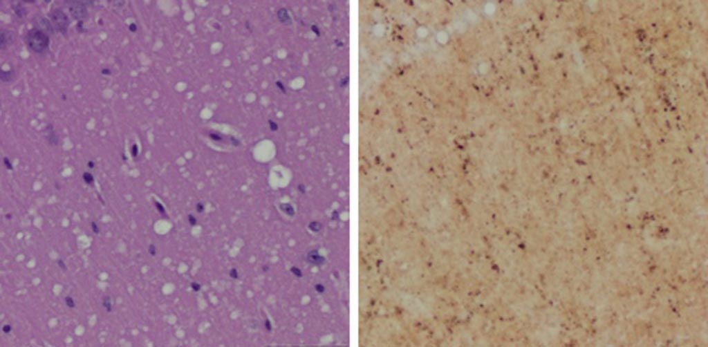Image: A Microscopic examination of brain tissues of prion-infected animals. (Left) Staining shows spongiform degeneration. (Right) Staining shows intense misfolded prion protein (Photo courtesy of Case Western Reserve University).