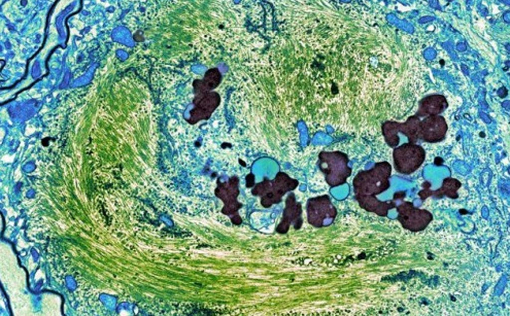 Image: A micrograph showing tangles of tau protein (green) in the brain cell of a person who had Alzheimer’s disease (Photo courtesy of Thomas Deerinck of the National Center for Microscopy and Imaging Research at the University of Califronia, San Diego School of Medicine).