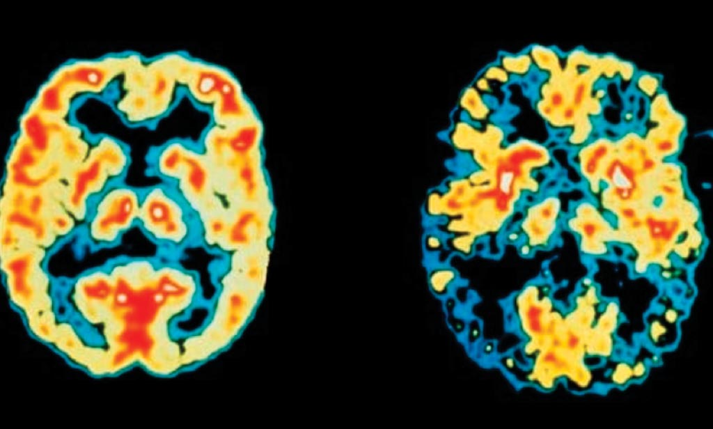 Image: Positron Emission Tomography (PET) scans of the brain of a normal patient (left) versus an Alzheimer\'s disease patient, which may have been detected earlier by measuring Neurofilament light chain (NfL) in CSF (Photo courtesy of Science Photo Library).