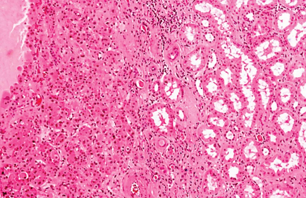 Микрофотография с большим увеличением почечной онкоцитомы. Опухолевые клетки (слева от изображения) расположены в гнездах, имеют слегка увеличенные ядра и более эозинофильную (темно-розовый) цитоплазму, чем почечные канальцы нормальных почек (справа на изображении). Фото любезно предоставлено Nephron.
