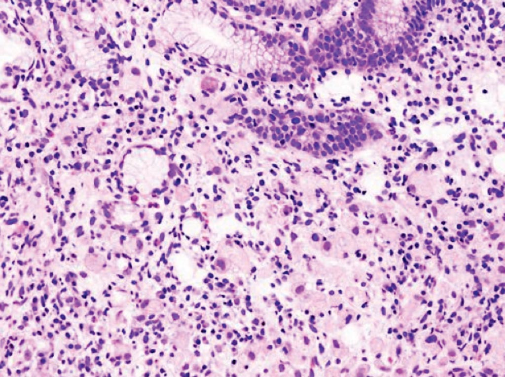 Image: A histopathology of gastric adenocarcinoma representing a signet ring cell variant identified in an endoscopic biopsy specimen (Photo courtesy of KGH).