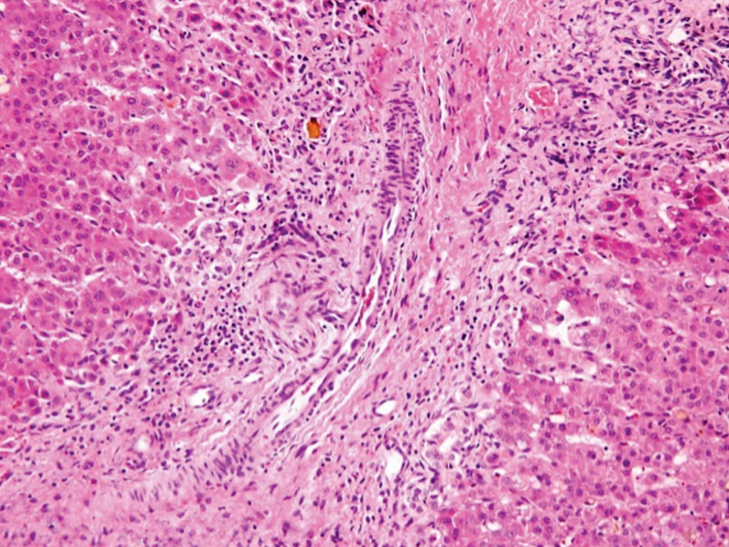 Image: A histopathology of the bile duct of a patient with biliary atresia: loss of bile ducts, brisk ductular reaction, and bile plugs (Photo courtesy of Hopkins GI Pathology).