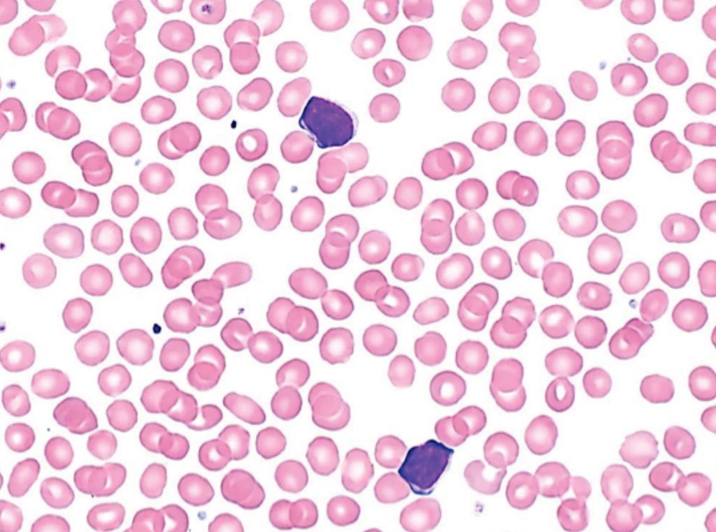 Image: A blood smear of a patient with monoclonal B-cell lymphocytosis. The two atypical lymphocytes are mature with a small rim of basophilic cytoplasm and clumped or cracked chromatin (Photo courtesy of Elizabeth Courville, MD).
