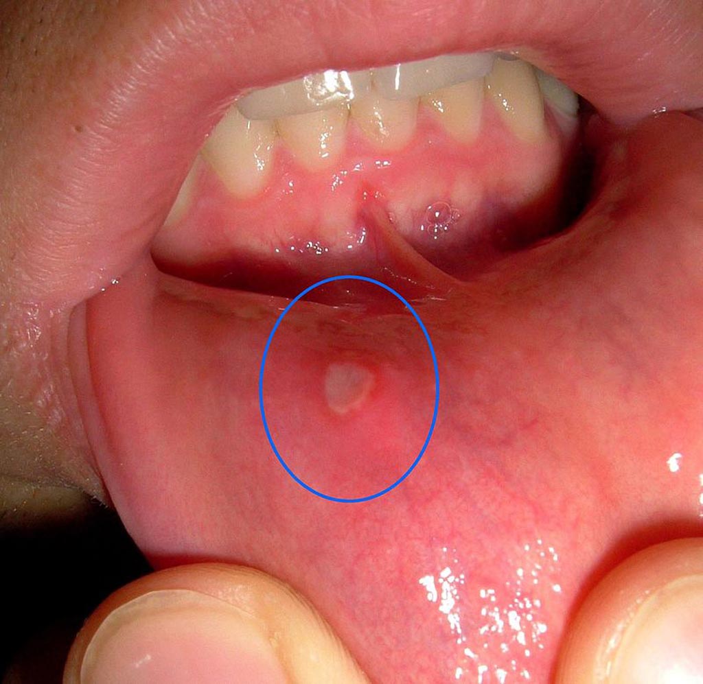 Image: A mouth ulcer (in this case associated with aphthous stomatitis) on the labial mucosa (lining of the lower lip) (Photo courtesy of Wikimedia Commons).
