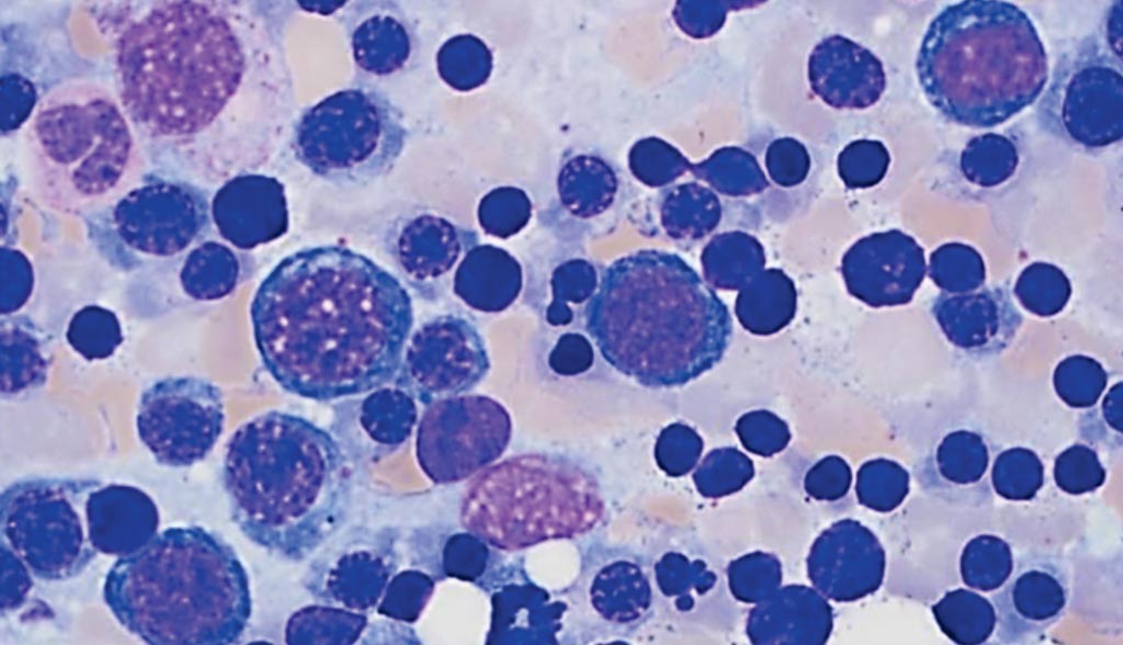 Image: Bone marrow aspirate of a patient with paroxysmal nocturnal hemoglobinuria showing erythroid hyperplasia with occasional nuclear budding consistent with stressed erythropoiesis (Photo courtesy of Katherine Calco).
