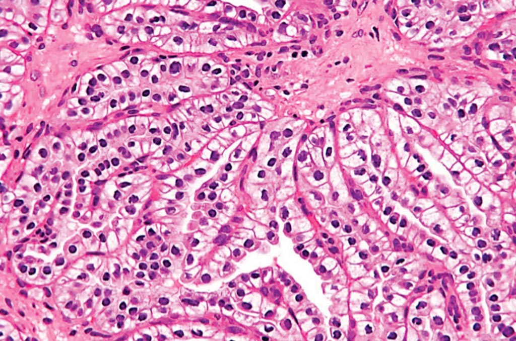Image: A histopathology of clear cell papillary renal cell carcinoma (Photo courtesy of Nephron).