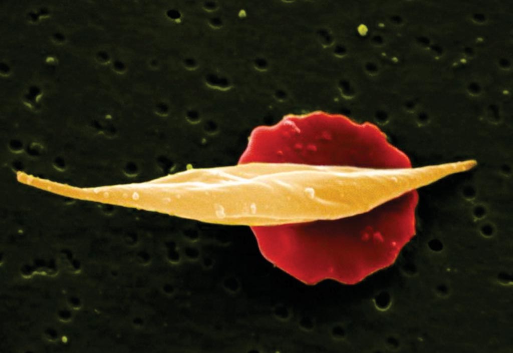 Image: A scanning electron micrograph (SEM) showing long sickle cell in front of more disc-shaped normal red cell (Photo courtesy of the Wellcome Trust).