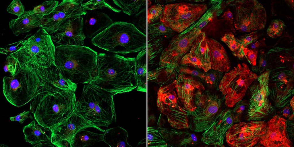 Image: The lack of dystrophin, shown in red, in an unedited human heart muscle cell with DMD (left) and the restoration of dystrophin in a CRISPR-edited human heart muscle cell (right) (Photo courtesy of the University of Texas Southwestern Medical Center).