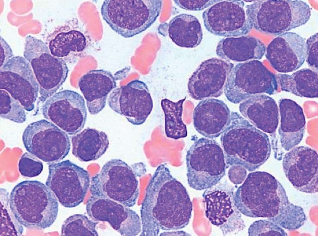 Image: A photomicrograph of the bone marrow of a pediatric patient with acute myeloid leukemia (Photo courtesy of St. Jude Children\'s Research Hospital).