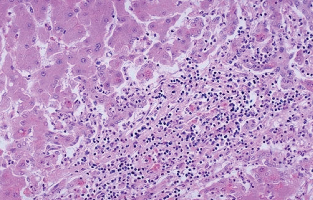Image: A histopathology of hepatocellular carcinoma: a mononuclear inflammatory cell infiltrate extends from portal areas and disrupts the limiting plate of hepatocytes which are undergoing apoptosis, the so-called interface hepatitis of chronic active hepatitis. In this case, the hepatitis B surface antigen (HBsAg) and hepatitis B core antibody (HBcAb) were positive (Photo courtesy of University of Utah Medical School).