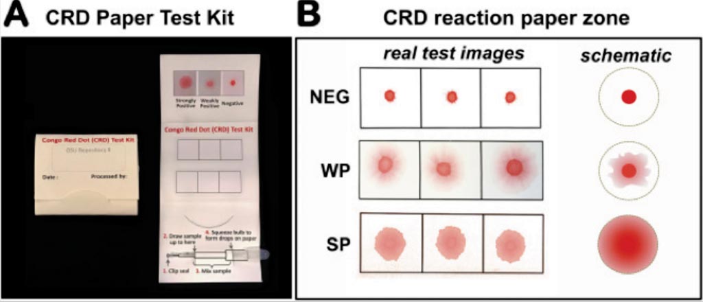 Image: The CR Dot (CRD) Paper Test: each kit had two label papers incorporated, and a visual colorimetric scale marked as strongly positive (SP), weak positive (WP) and negative (NEG). The kit contained a syringe prefilled with Congo Red dye (Photo courtesy of The Ohio State University Wexner Medical Center).