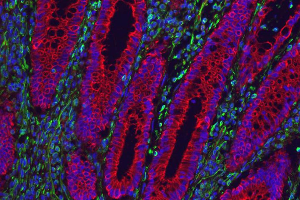 Image: The cells that line the gut of an ulcerative colitis patient are inflamed and filled with PAI-1 protein (shown in red), which is linked to blood clotting. Nuclei are shown in blue, and other intestinal cells are marked in green (Photo courtesy of Gerard Kaiko, Washington University School of Medicine).