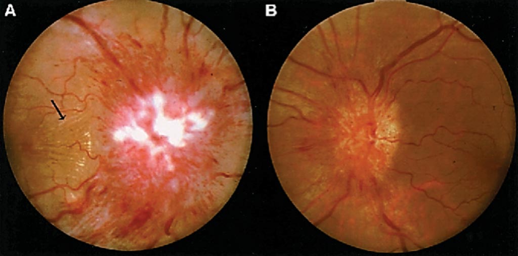 Image: Fundus appearance for a woman with Idiopathic Intracranial Hypertension (IIH), showing severe papilledema in the right eye (A) and moderate papilledema in the left eye (B) (Photo courtesy of Devin K. Binder MD, PhD, and colleagues).