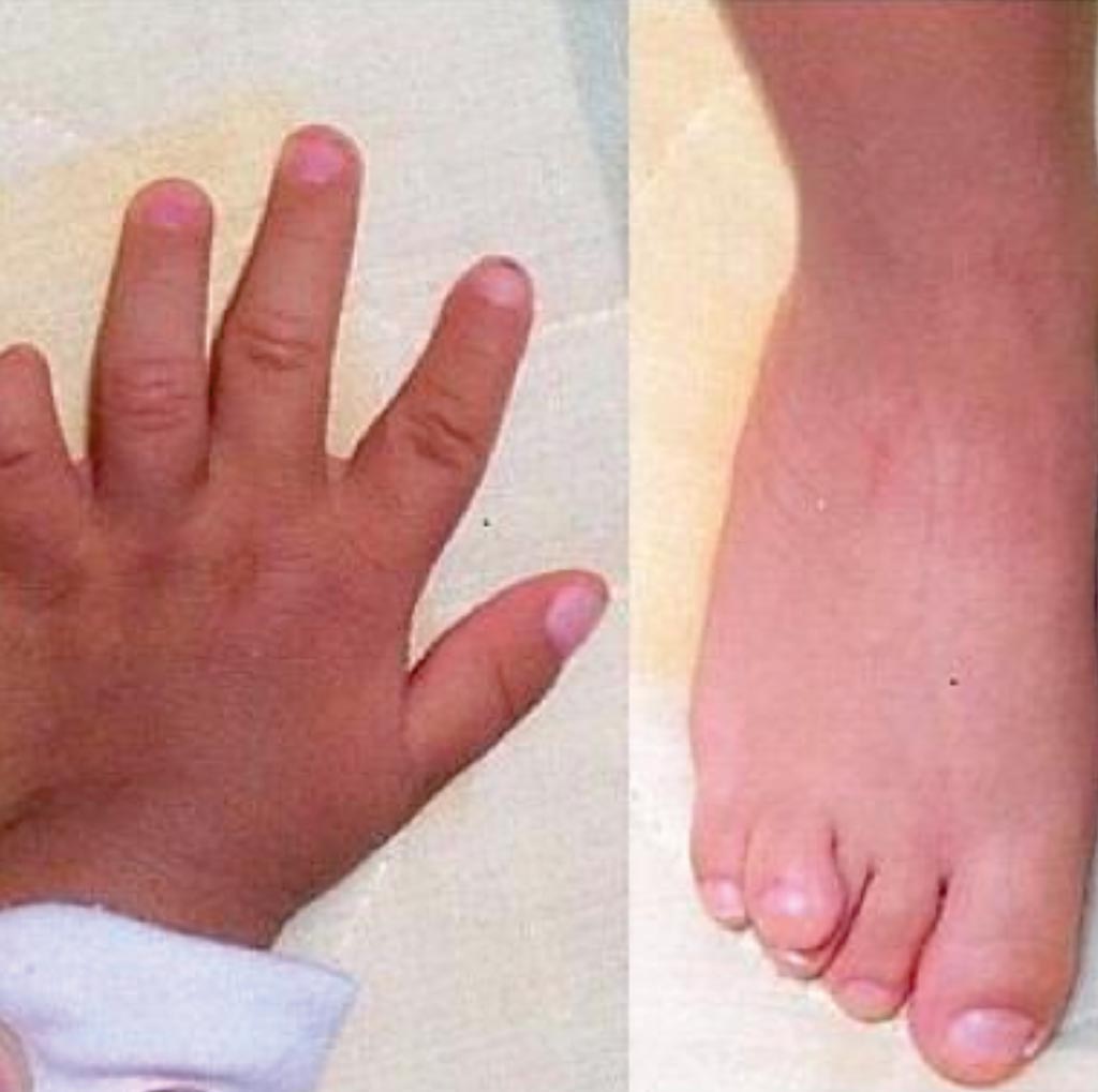 Image: The hand and foot a patient with Opitz C Syndrome (Photo courtesy of Dr. Jorge Avina).