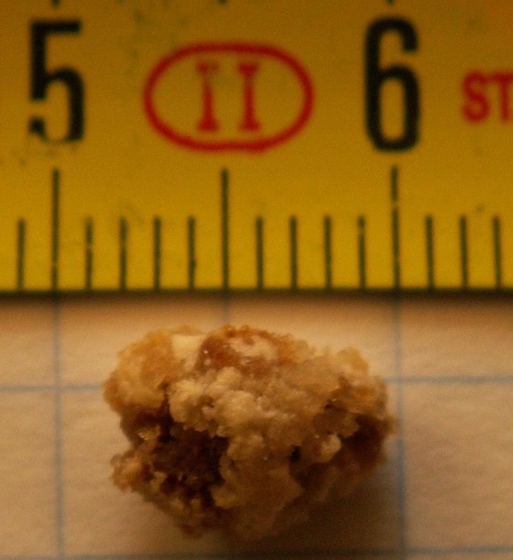 Image: A color photograph of a kidney stone – eight millimeters in length (Photo courtesy of Wikimedia Commons).