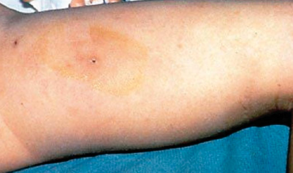 Image: An area of mild erythema around varicella lesion on the thigh of a young boy progressed to necrotizing fasciitis caused by group A Streptococcus (Photo courtesy of Dr. E. P. Dellinger, MD).