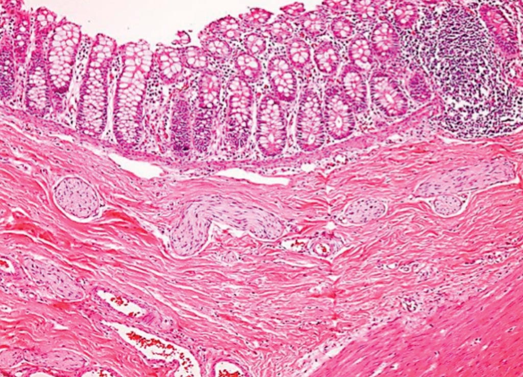 Image: A histopathology of Hirschsprung’s disease, which is characterized by the absence of parasympathetic ganglion cells in both submucosal as well as myenteric plexuses in the distal gastrointestinal tract (Photo courtesy of Dr. Dharam Ramnani).