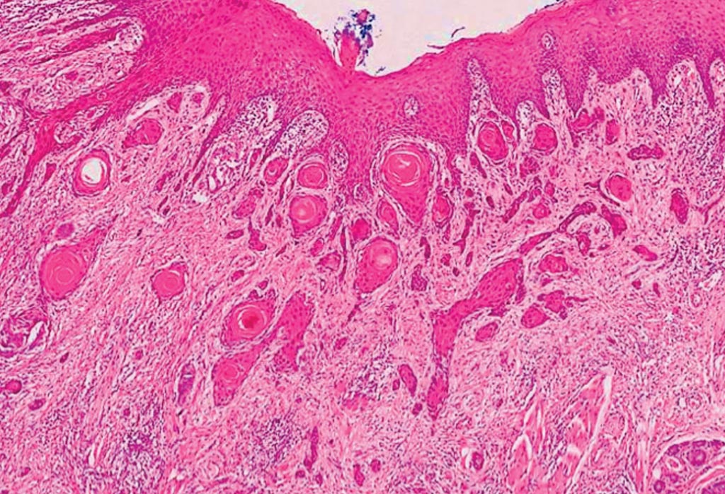 Image: A histopathology of oral cancer: tumor islands can be seen infiltrating the connective tissues deep to the overlying oral epithelium. This carcinoma is moderately differentiated with a non-cohesive invasive pattern (Photo courtesy of University of Sheffield).