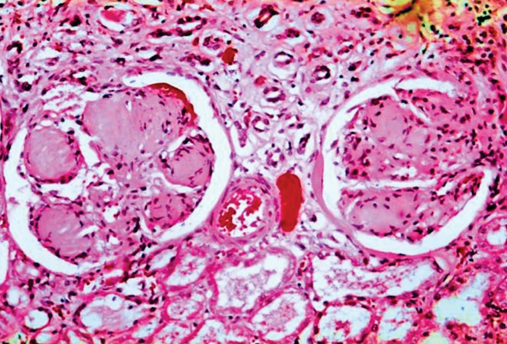 Image: Nodular glomerulosclerosis in the kidney of a patient with diabetic nephropathy; the acellular light purple areas within the capillary tufts are the destructive mesangial matrix deposits (Photo courtesy of the CDC).