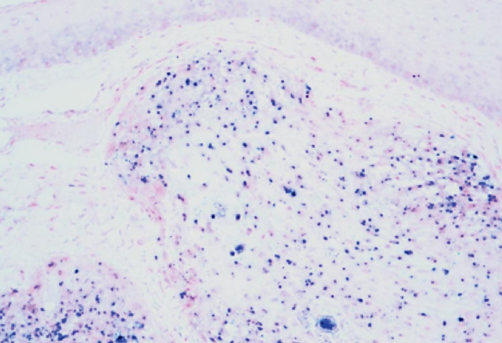 Image: A photomicrograph of human papilloma virus associated oropharyngeal cancer. The tissue has been stained to show the presence of the virus by in situ hybridization (Photo courtesy of Jennifer L. Hunt, MD).