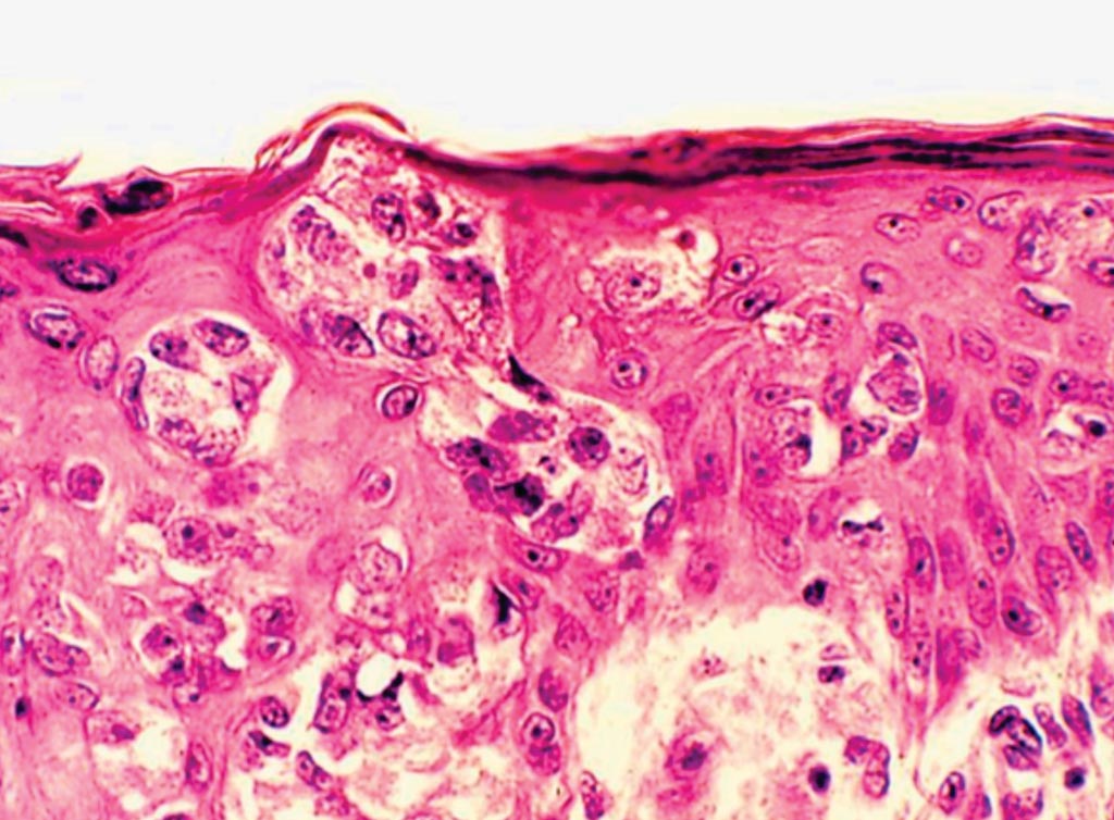 Image: A histopathology of castration-resistant prostate cancer (Photo courtesy of Andrew J. Armstrong, MD, ScM).