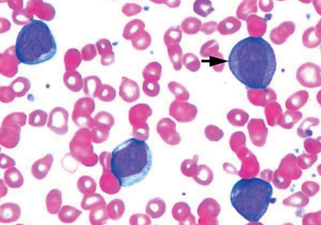 Пленка крови пациента с острым миелоедным лейкозом, определяемая присутствием более 90% миелобластов в крови и/или костном мозге (фото любезно предоставлено Pathpedia).