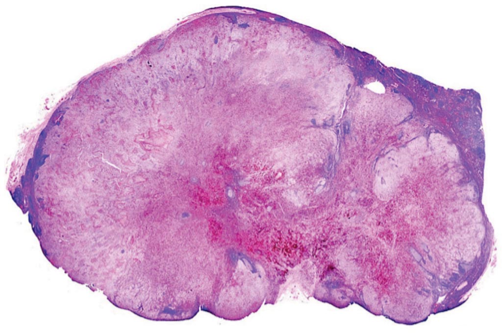 Image: A lymph node with almost complete replacement by metastatic melanoma. The brown pigment is focal deposition of melanin (Photo courtesy of Gabriel Caponetti, MD).
