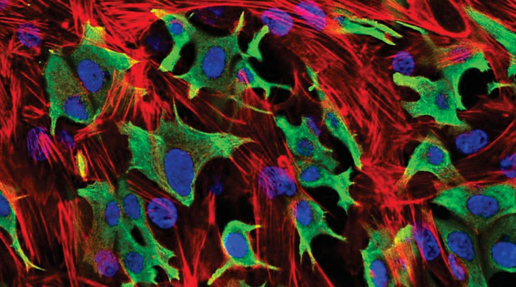 Breast cancer cells invading through a layer of fibroblasts. Hormone receptor-positive breast cancer has been found to spread faster when the microbiome is disrupted (Photo courtesy of Institute of Cancer Research).