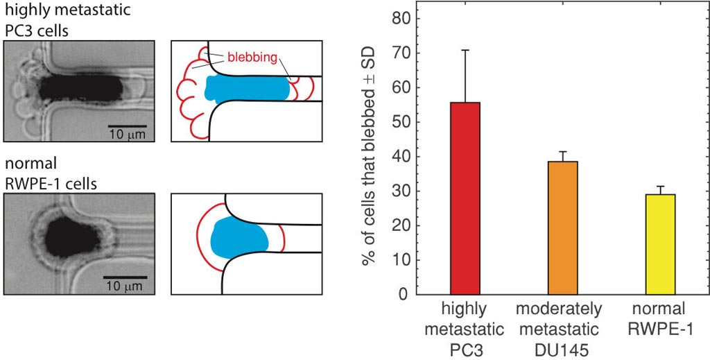 Слева: изображения блеббинга клетки высокометастатического рака предстательной железы РС3 (вверху) и нормальная клетка предстательной железы (без пузырьков) RWPE-1, подаваемые в микрофлюидный канал. Середина: контуры изображений слева подчеркивают блеббинг и деформацию клетки. Справа: процент высокометастатических клеток PC3, умеренно метастатических клеток DU145 и нормальных клеток RWPE-1, которые пузырились, будучи пропущенными через канал вместе со стандартным отклонением (SD). Фото любезно предоставлено Фазлом Хуссейном (Fazle Hussain), Техасский технический университет.
