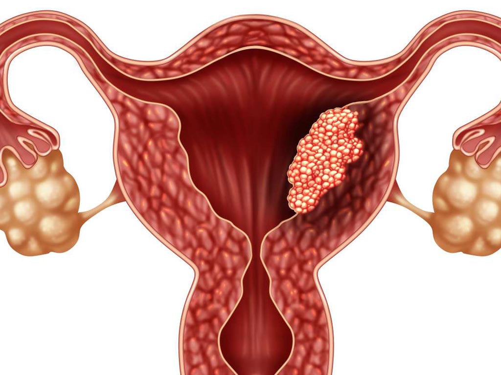 Image: Non-invasive sampling methods are being considered as the basis for genomic diagnosis of endometrial cancer (Photo courtesy of Medical News Today).
