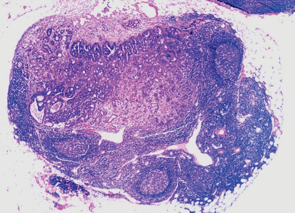 Image: A histopathology of lymph node with metastatic adenocarcinoma of the colon (Photo courtesy of Dr. Ed Uthman M.D).