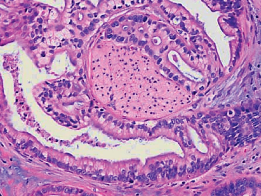 Гистопатология протоковой аденокарциномы поджелудочной железы. В данном примере аденокарцинома обернулась вокруг нерва (центр изображения). Фото любезно предоставлено JHM.