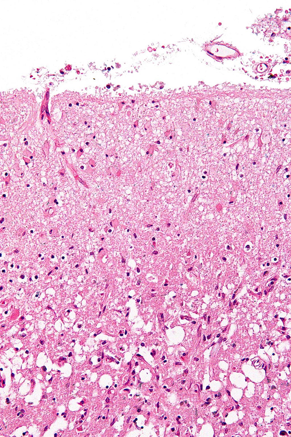 Image: A micrograph of the superficial cerebral cortex showing neuron loss and reactive astrocytes in a person that has had a stroke (Photo courtesy of Wikimedia Commons).