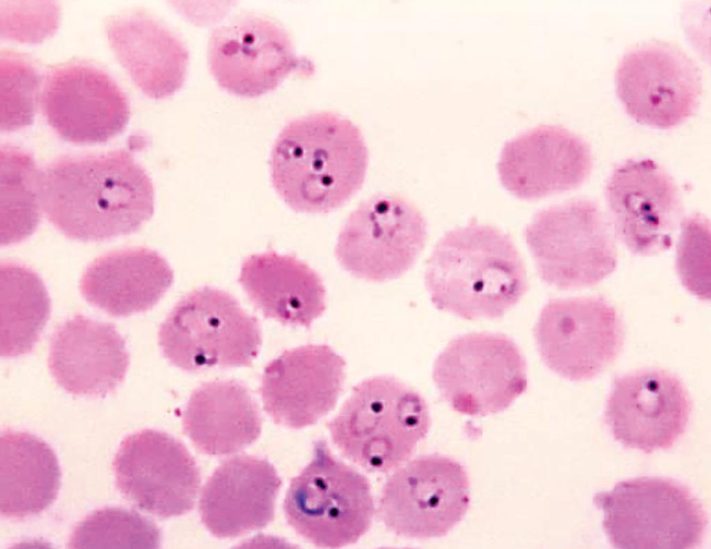 Image: A Giemsa-stained, thin film blood smear that shows the presence of numerous of ring-form, Plasmodium falciparum trophozoites, with some infected red blood cells (RBCs) harboring multiple organisms (Photo courtesy of Steve Glenn/CDC).