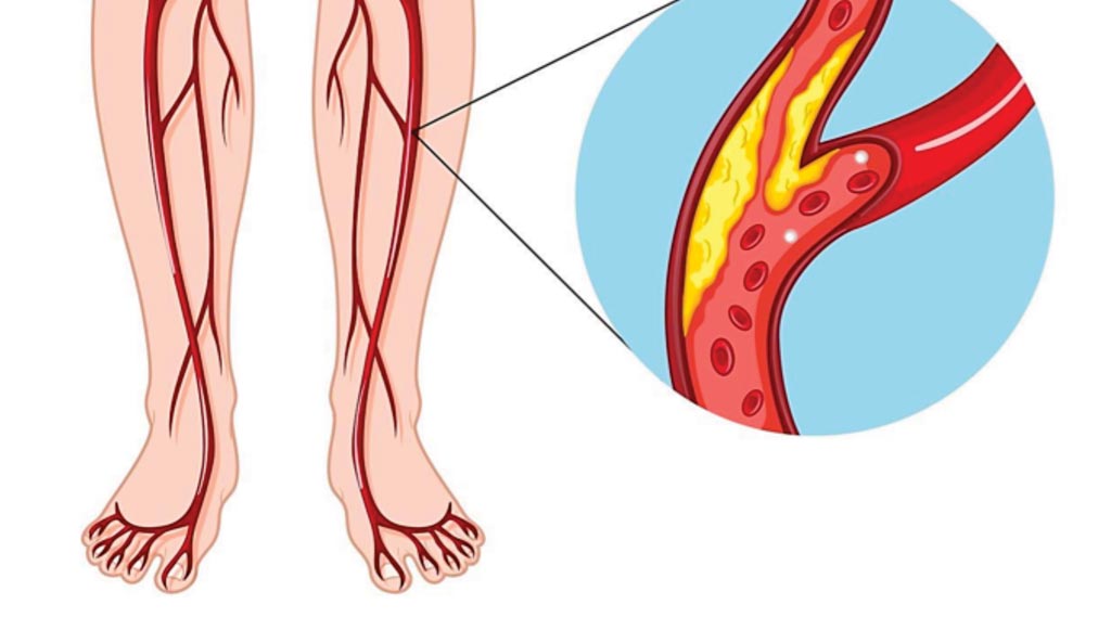 Image: A diagram illustrating peripheral artery disease in the lower limbs (Photo courtesy of US National Institute of Health).