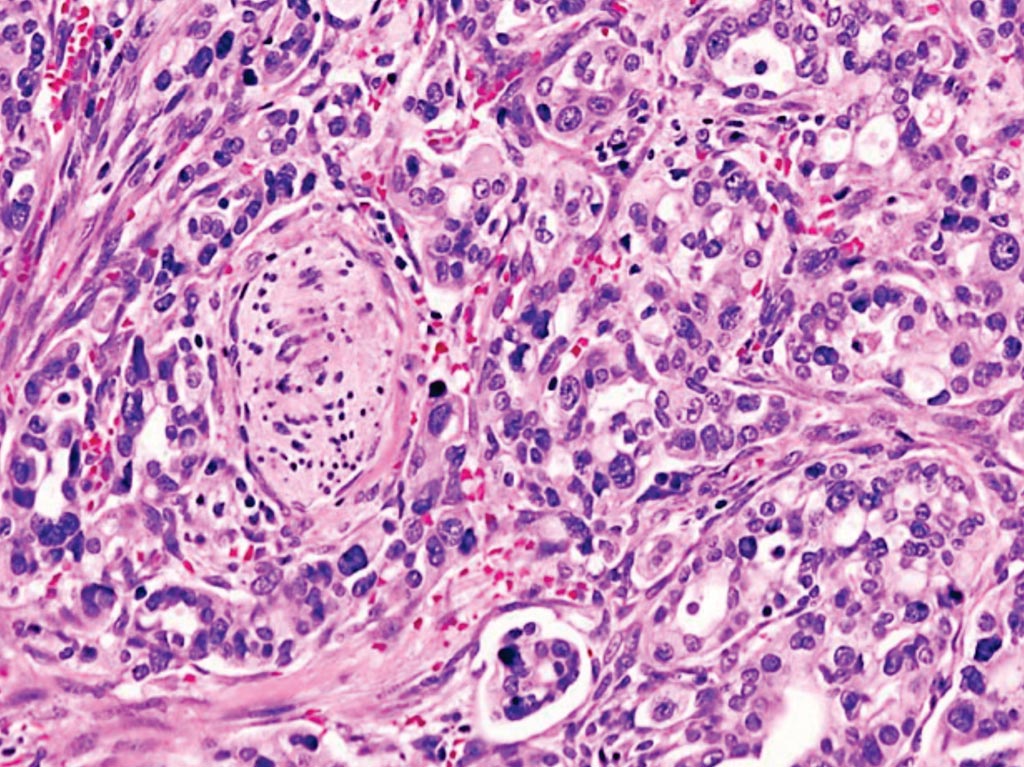 Image: A histopathology of pancreatic ductal adenocarcinoma, the most common type of pancreatic cancer, arising in the pancreas head region (Photo courtesy of KGH).