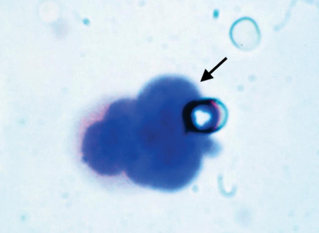 Image: A circulating tumor cell (arrow) diagnosed by the isolation by size of epithelial tumor cells (ISET) test (The pores of the filter are also visible) (Photo courtesy of Chichiselector).
