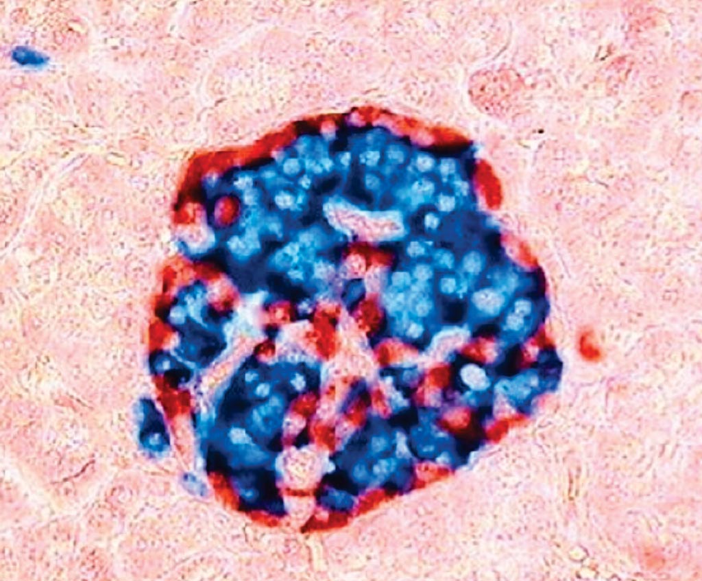 Image: Human pancreatic islet stained with glucagon antibody (red) and insulin antibody (blue). Glucagon is produced by alpha cells, while beta cells produce insulin (Photo courtesy of University of Turku).
