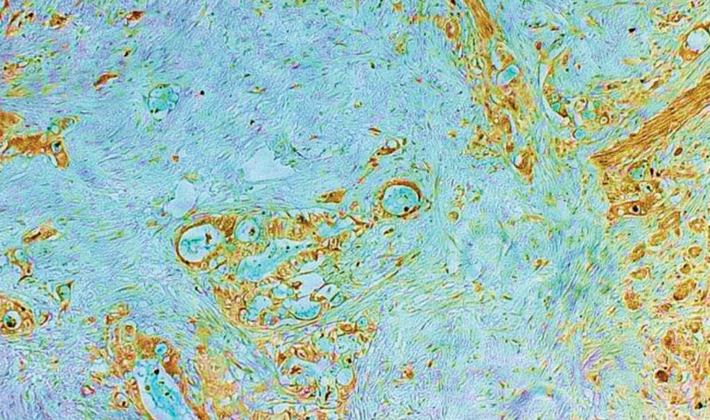 Image: A histopathology of pancreatic cancer; Scientists studying a highly cancer-prone family have identified a rare, inherited gene mutation that dramatically raises the lifetime risk of pancreatic and other cancers (Photo courtesy of the Dana-Farber Cancer Institute).