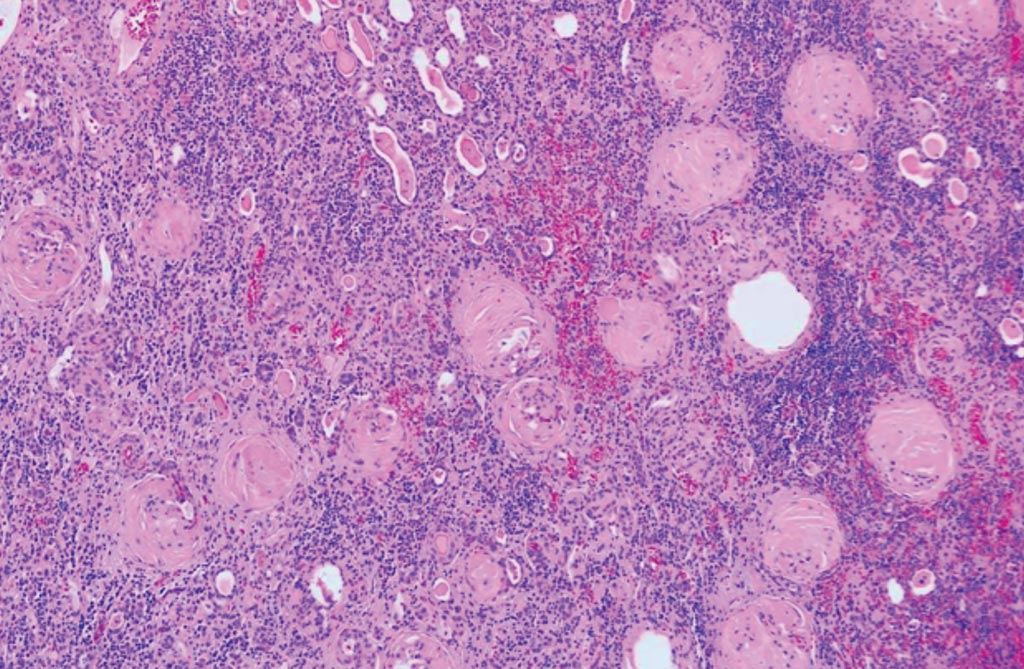 Image: A photomicrograph showing numerous completely sclerotic glomeruli and severe chronic tubulointerstitial nephritis from a patient with end-stage kidney disease (Photo courtesy of Dr. Jian-Hua Qiao, MD, FCAP).