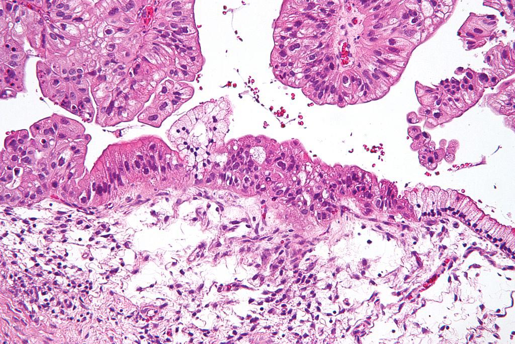 Image: A micrograph of a low malignant potential (LMP) mucinous ovarian tumor. The micrograph shows: Simple mucinous epithelium (right) and mucinous epithelium that pseudo-stratifies (left - diagnostic of a LMP tumor). Epithelium in a frond-like architecture is seen at the top of image (Photo courtesy of Wikimedia Commons).