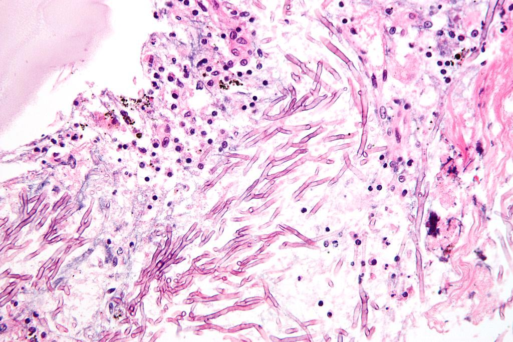 Image: A micrograph showing a mycosis (aspergillosis). The Aspergillus (which is spaghetti-like) is seen in the center and surrounded by inflammatory cells and necrotic debris (Photo courtesy of Wikimedia Commons).