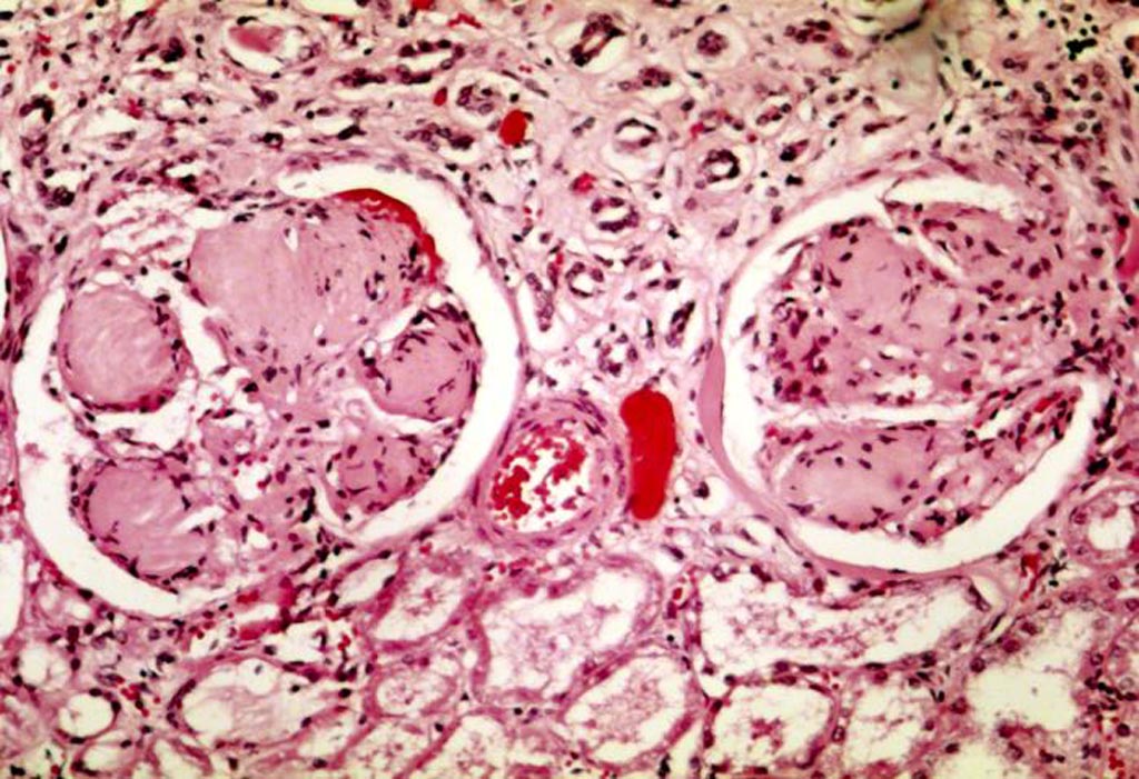 Image: A photomicrograph showing two glomeruli in diabetic kidney disease: the acellular light purple areas within the capillary tufts are the destructive mesangial matrix deposits (Photo courtesy of Wikimedia Commons).
