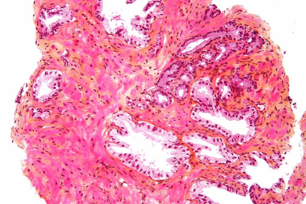 Image: Micrograph of a prostate biopsy showing normal prostatic glands and glands of prostate cancer (prostatic adenocarcinoma) (Photo courtesy of Wikimedia Commons).