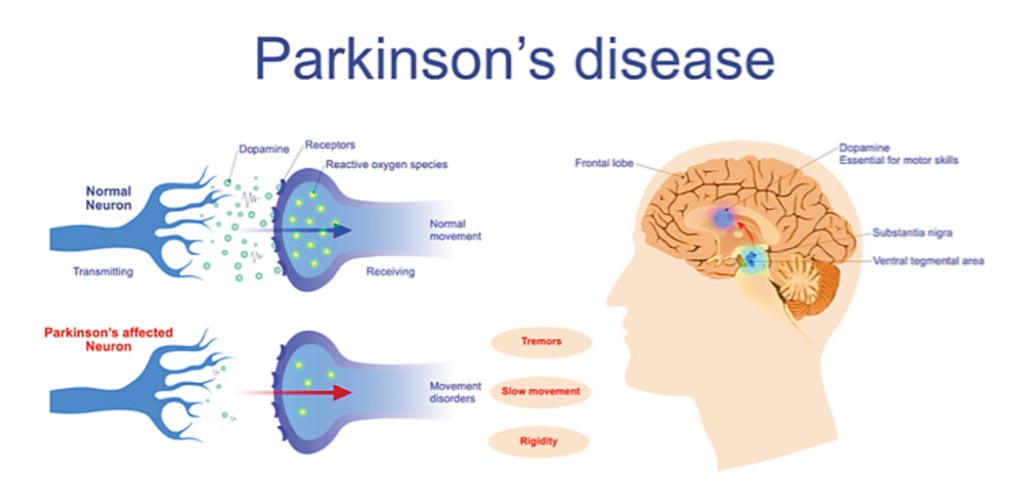 Image: A specific Parkinson’s gene mutation has been linked to a higher risk of leukemia and colon cancer (Photo courtesy of BioNews Services).