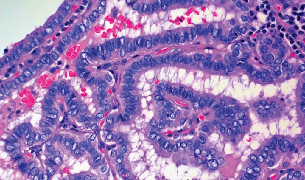 Image: A microscope image of thyroid cancer cells, specifically papillary thyroid carcinoma, or PTC (Photo courtesy of Wendong Yu/Baylor College of Medicine).