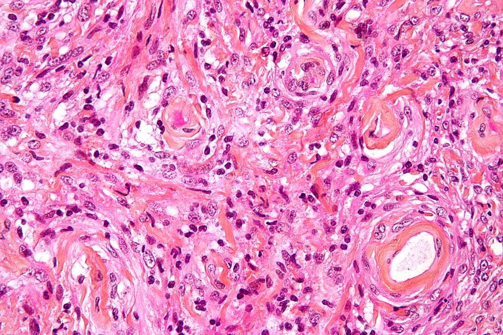 Image: High magnification micrograph of a meningioma showing the characteristic whirling (Photo courtesy of Wikimedia Commons)