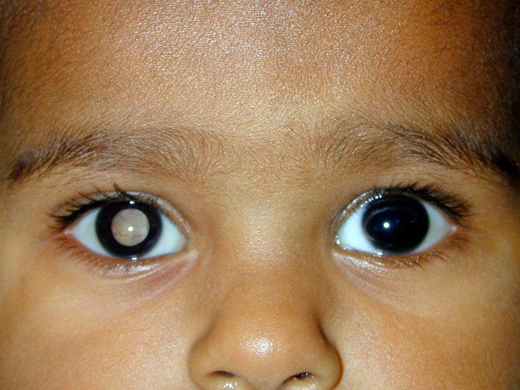 Image: Retinoblastoma is cancer of the eye and cannot be biopsied. Aqueous humor is superior to blood to diagnose retinoblastoma (Photo courtesy of Aravind Eye Hospital).