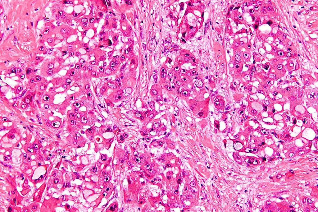 Image: Photomicrograph of histology of fibrolamellar hepatocellular carcinoma, showing large polygonal tumors cells with granular eosinophilic cytoplasm (Photo courtesy of Nephron)